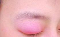 ?眼皮腫是怎么回事，眼皮腫是怎么快速消除